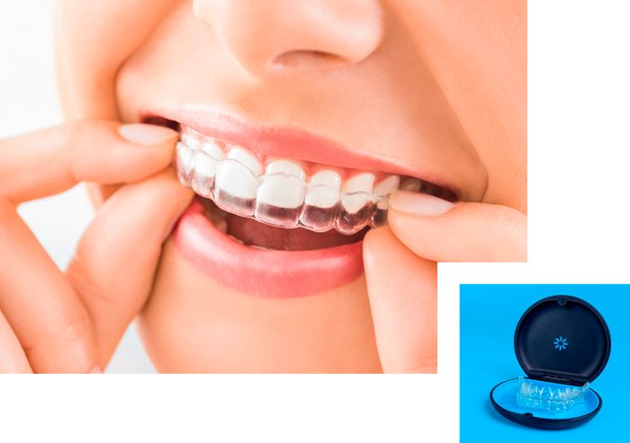 a close up of a woman 's mouth with invisalign on her teeth .