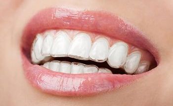 a close up of a woman 's mouth with clear braces on her teeth .