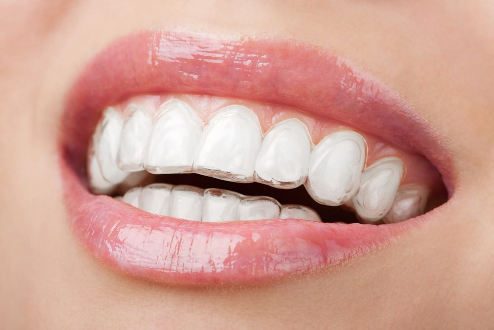 a close up of a woman 's mouth with white teeth .