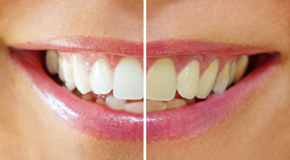 A before and after picture of a woman 's teeth.