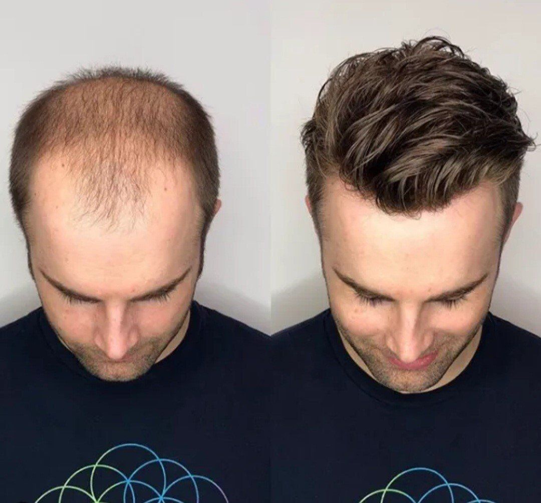Osez le complément capillaire ! Nicolas coiffure.
