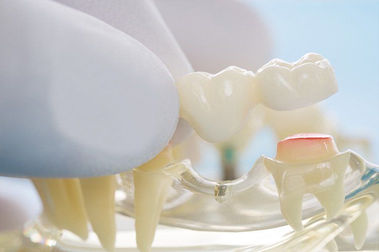 A close up of a person holding a model of teeth.