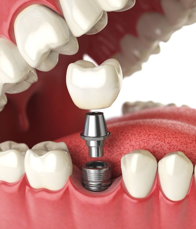 Tooth Implants — Bytes Of Byron Eco Dentistry in Byron Bay, NSW
