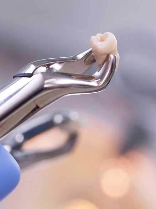 Tooth Extraction — Bytes Of Byron Eco Dentistry in Byron Bay, NSW