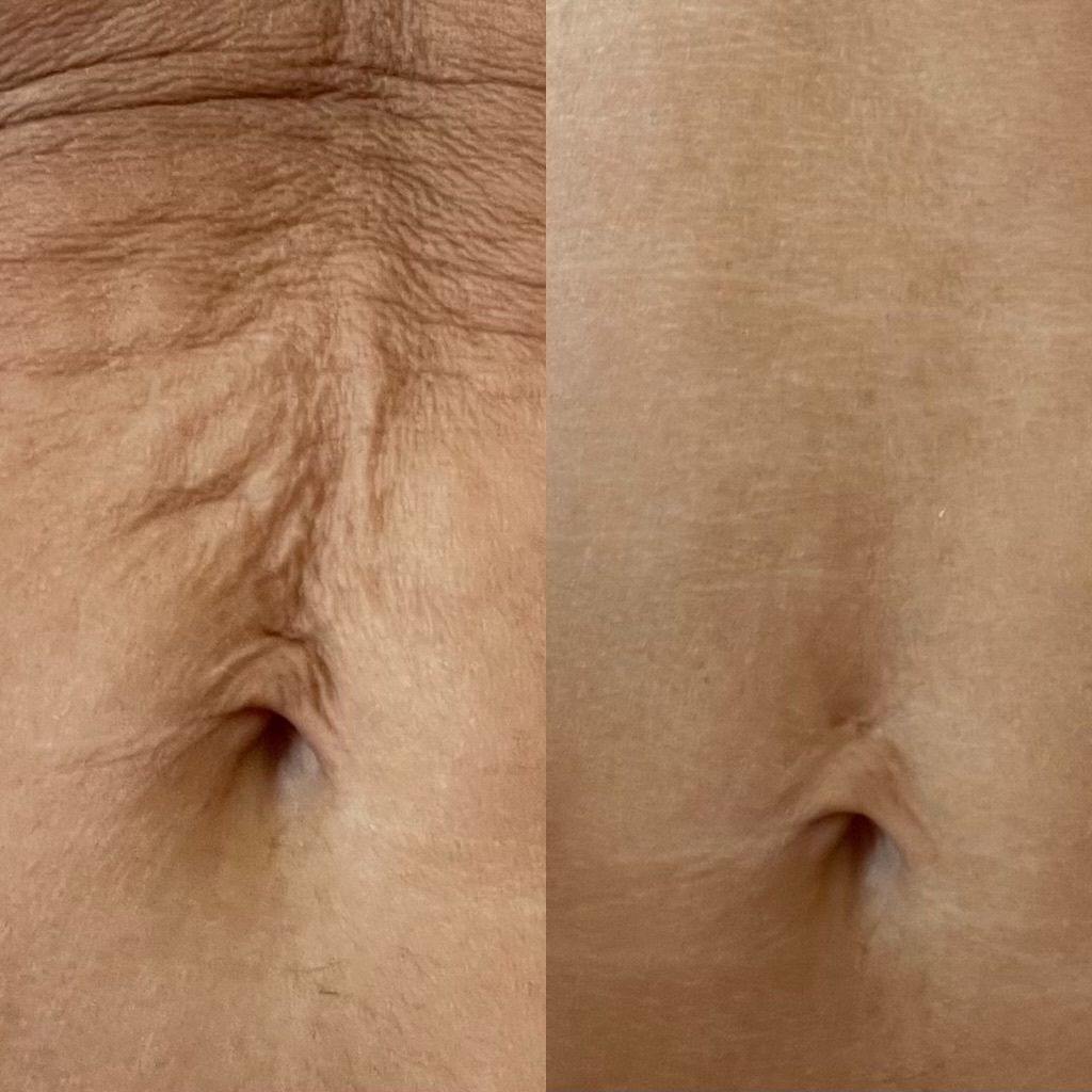 Two side-by-side images of a person's navel. Left: wrinkled skin. Right: smooth skin.