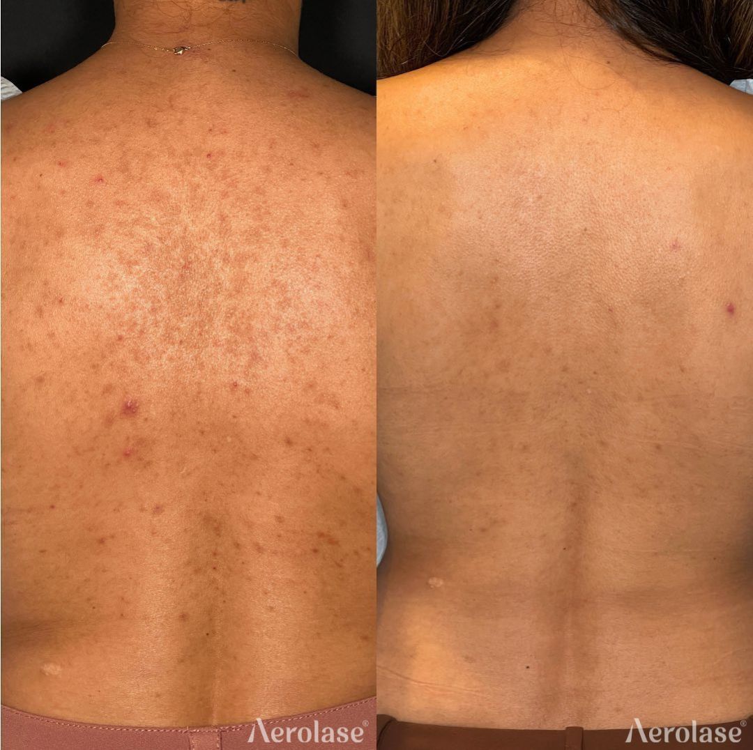 Comparison of a person's back before and after acne treatment, showing improvement in skin clarity.