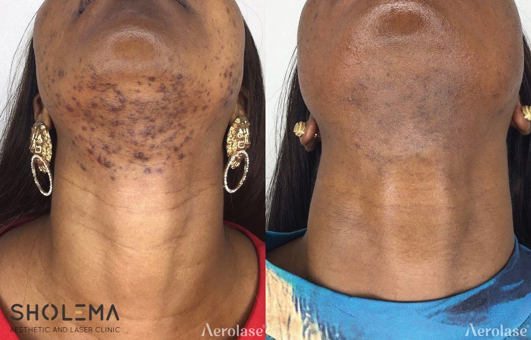 Before and after comparison of laser hair removal on a person's chin and neck.