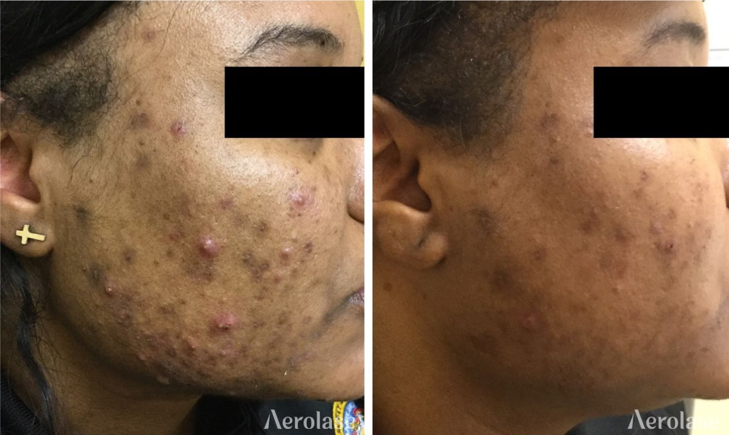 Before and after photos of acne treatment on a person's face; reduced breakouts and some discoloration.
