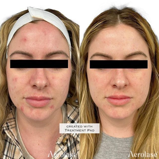 Before and after comparison of a person's face. Left side: acne. Right side: clearer skin.
