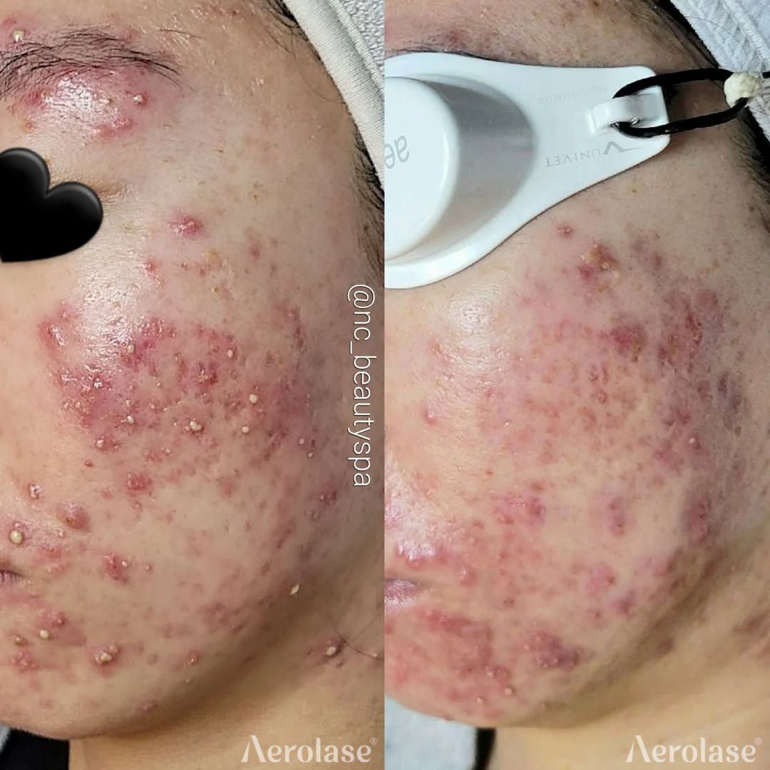 Acne before and after treatment on a person's cheek. Red bumps and spots before, reduced after.