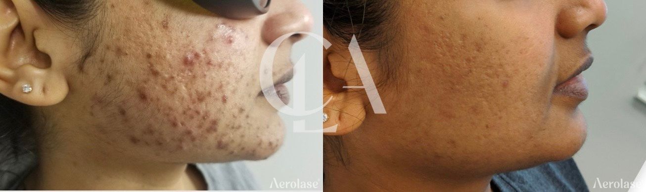 Before and after comparison of skin with acne treatment.