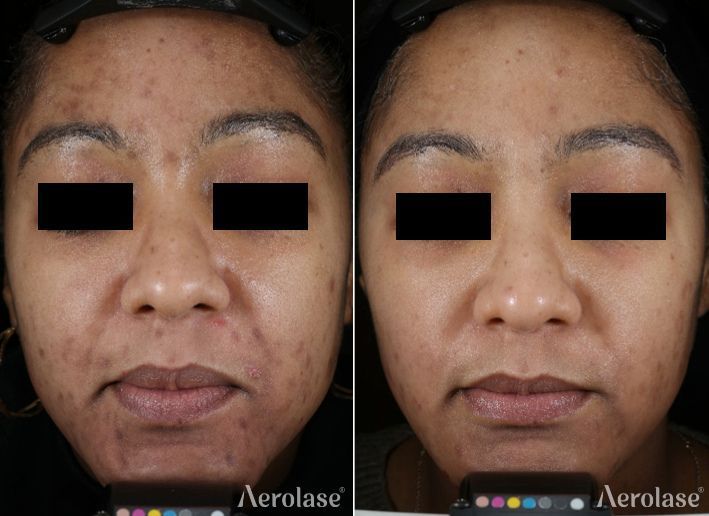Side-by-side comparison of a face before (left) and after (right) laser skin treatment. Skin tone appears improved.