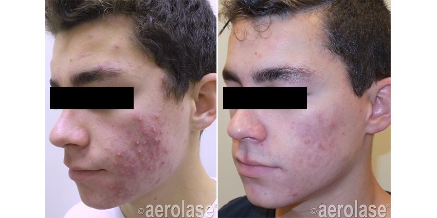 Side-by-side comparison of a person's face. The left side has acne, and the right side shows improvement after treatment.