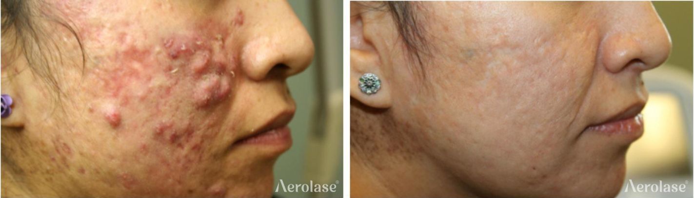 Before and after photos of skin treatment on a face; the skin's texture improves significantly.