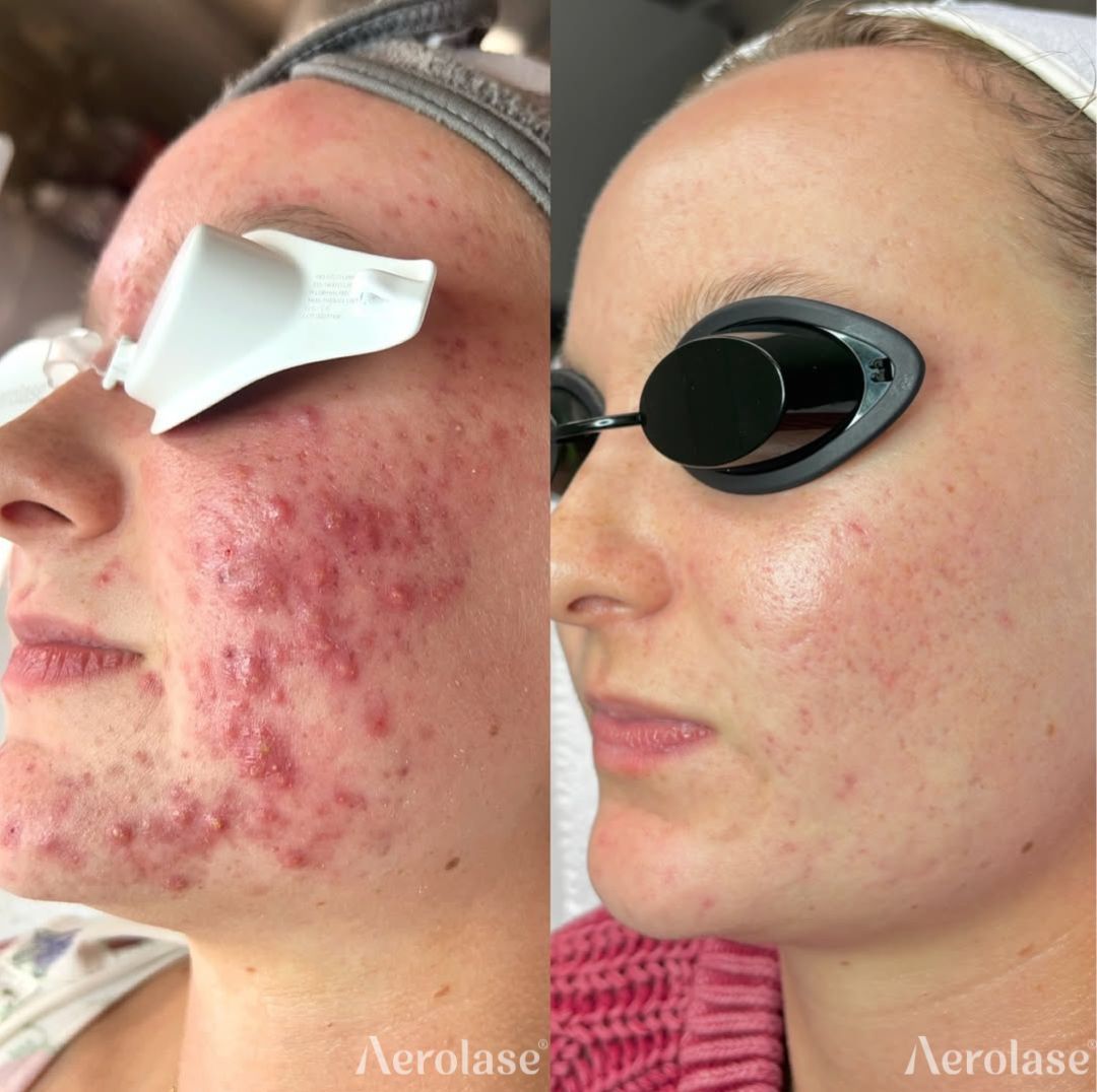 Before and after comparison of a person's face. Left side has severe acne. Right side shows reduced acne with smoother skin.