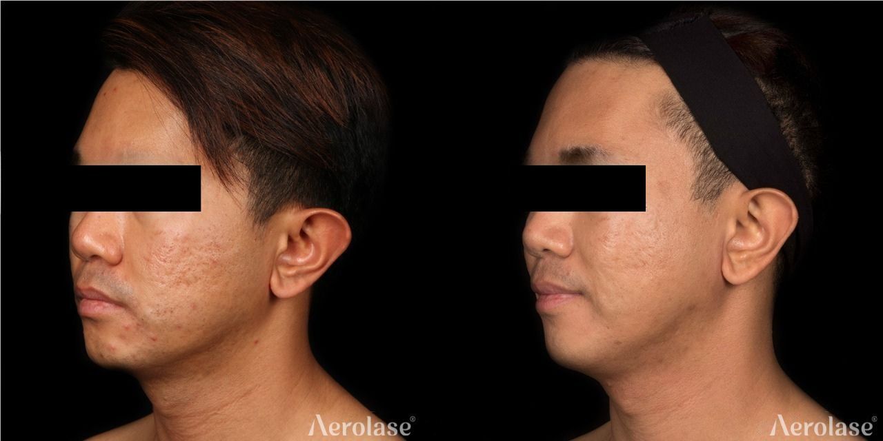 Two side-profile portraits of a person's face and neck, before and after a procedure. The after photo shows smoother skin.