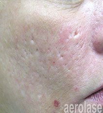 Close-up of a person's cheek with noticeable acne scars and reddish skin.