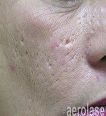Close-up of a person's cheek with visible acne scars, primarily indentations.