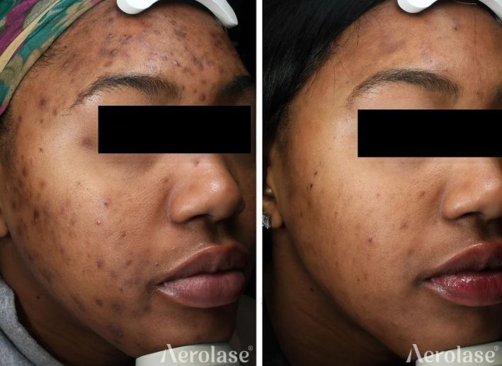 Before-and-after photos of a person's face. Left side: acne. Right side: reduced acne.