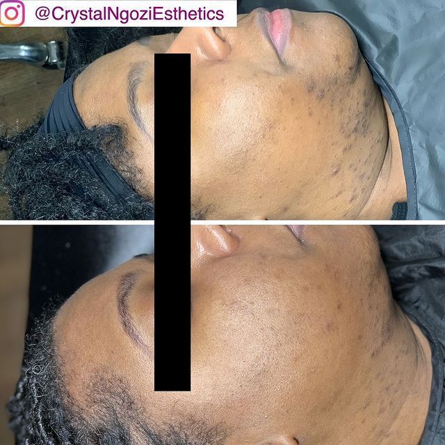 Before and after view of a person's skin. Visible improvement in texture and tone.