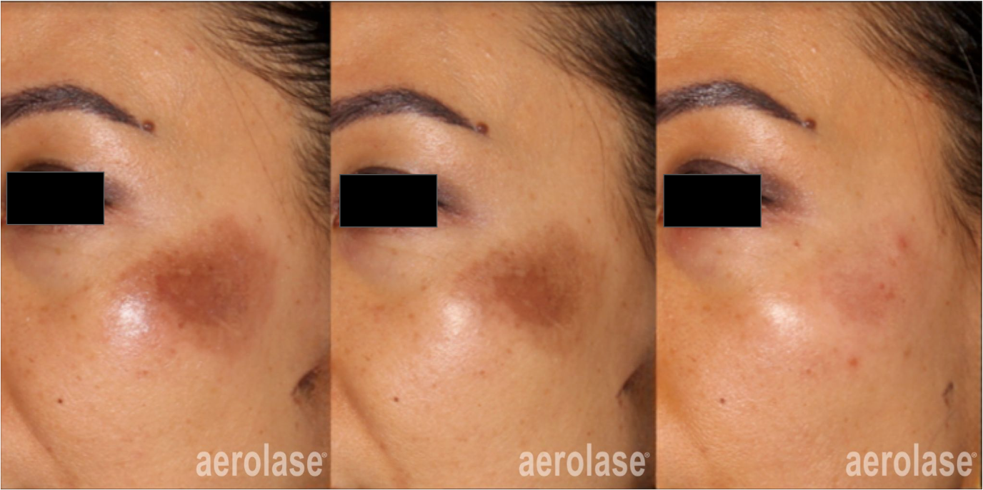Before and after photos showing reduction of brown pigmentation on cheek after Aerolase laser treatment.