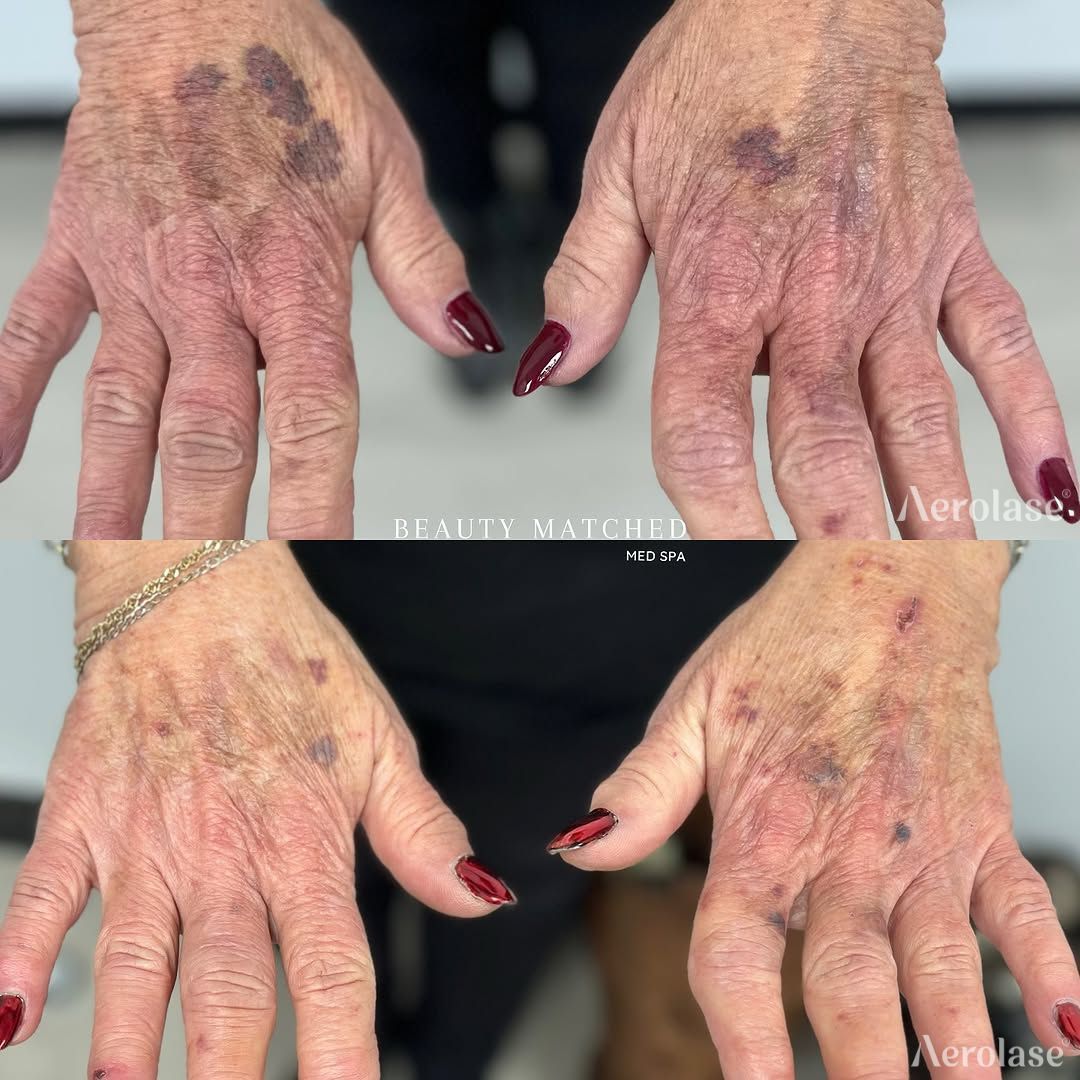 Hands with age spots before and after a treatment, featuring dark spots and visible veins.
