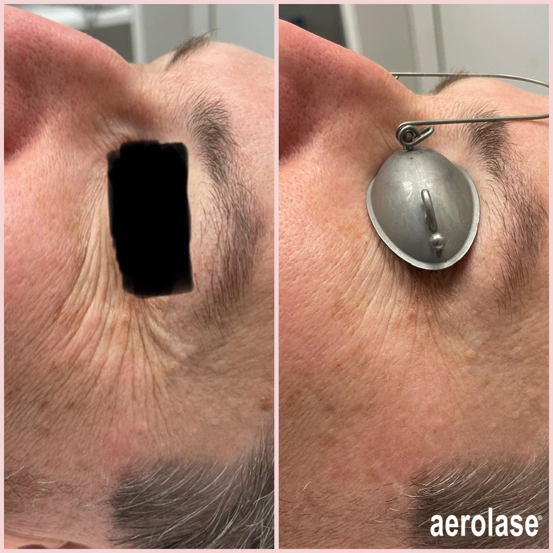 Two side-by-side photos of a forehead. Left: rectangle void. Right: metal eye shield held over the eye.