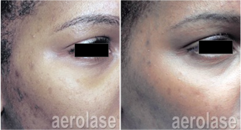 Side-by-side view of a person's face. Left side shows acne scars. Right side shows improvement after laser treatment.