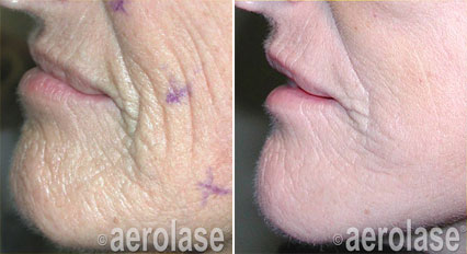 Side-by-side comparison of a person's skin before and after a procedure, showing reduced wrinkles.