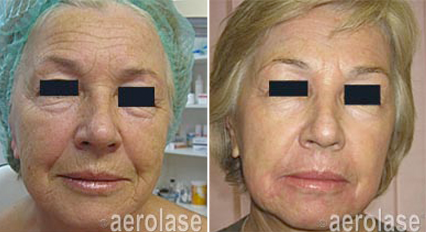 Side-by-side comparison of woman's face before and after skin treatment, showing reduced wrinkles and improved skin tone.