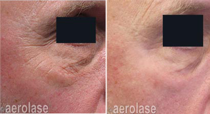 Comparison of a person's eye area: before and after laser treatment for wrinkles.