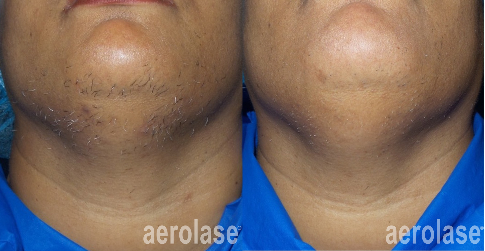 Side-by-side comparison of a chin before and after hair removal treatment, with visibly reduced hair in the after image.