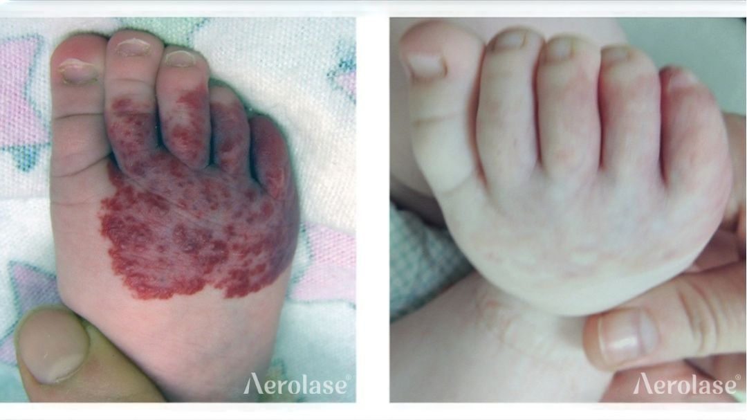 Comparison of a baby's foot with a large, dark red birthmark before and after laser treatment, showing clearing.