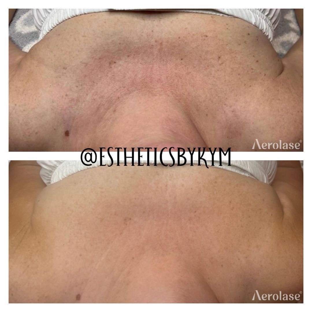 Before and after view of chest, showing reduction in redness and blemishes after Aerolase treatment.