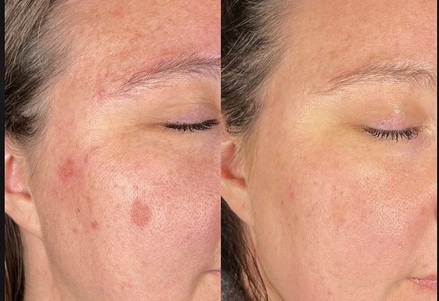 Before and after photos of a person's face; visible skin blemishes and sunspots reduce significantly.