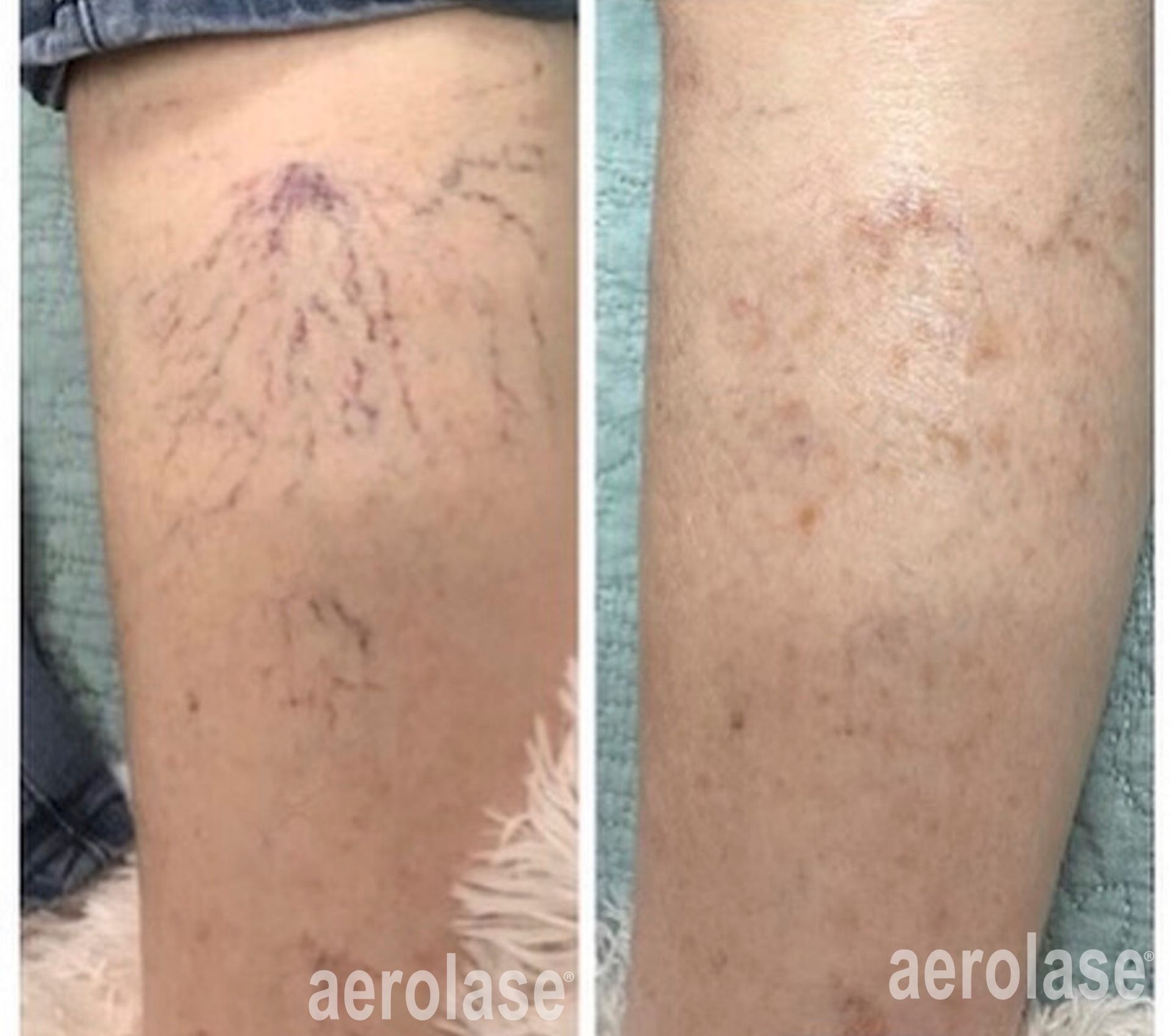 Leg with before and after laser treatment, visible veins disappear.