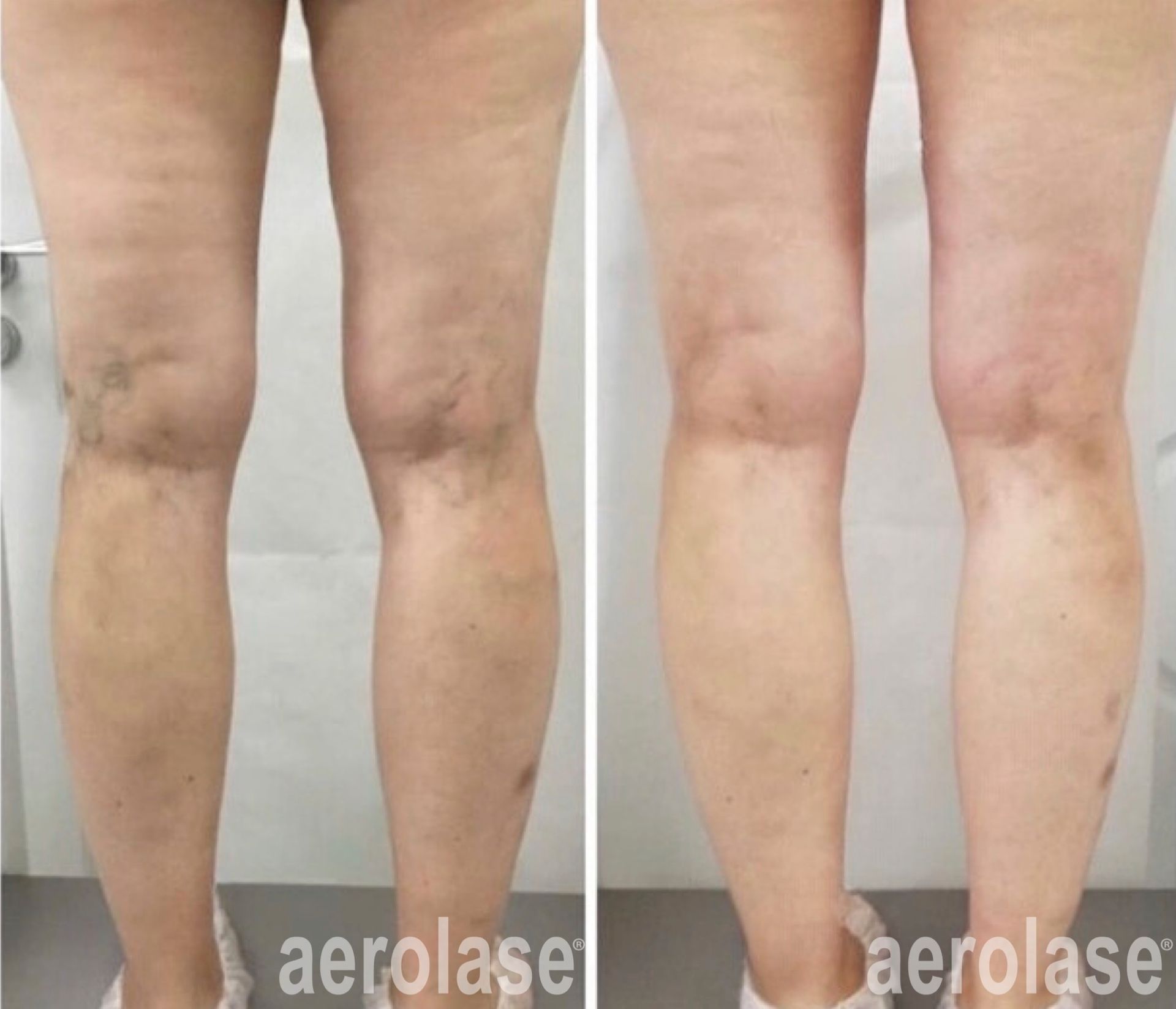 Legs before and after vein treatment; visible veins reduced after procedure.