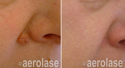 Before and after views of skin near the nose; a raised skin lesion is removed, leaving smoother skin.