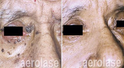 Before and after photos of a person's eye area. Skin lesions are visible before treatment, significantly reduced after.