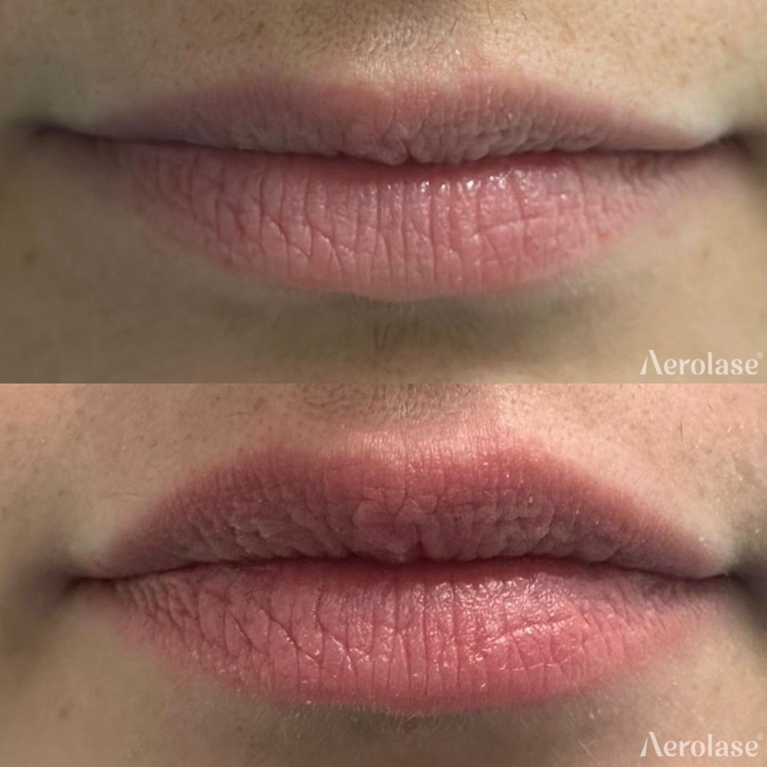 Comparison of lips, pre-treatment and post-treatment, showing increased fullness and color.