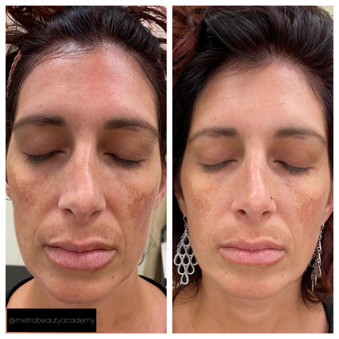Side-by-side comparison shows a woman's face before and after skin treatment, with reduced dark spots.