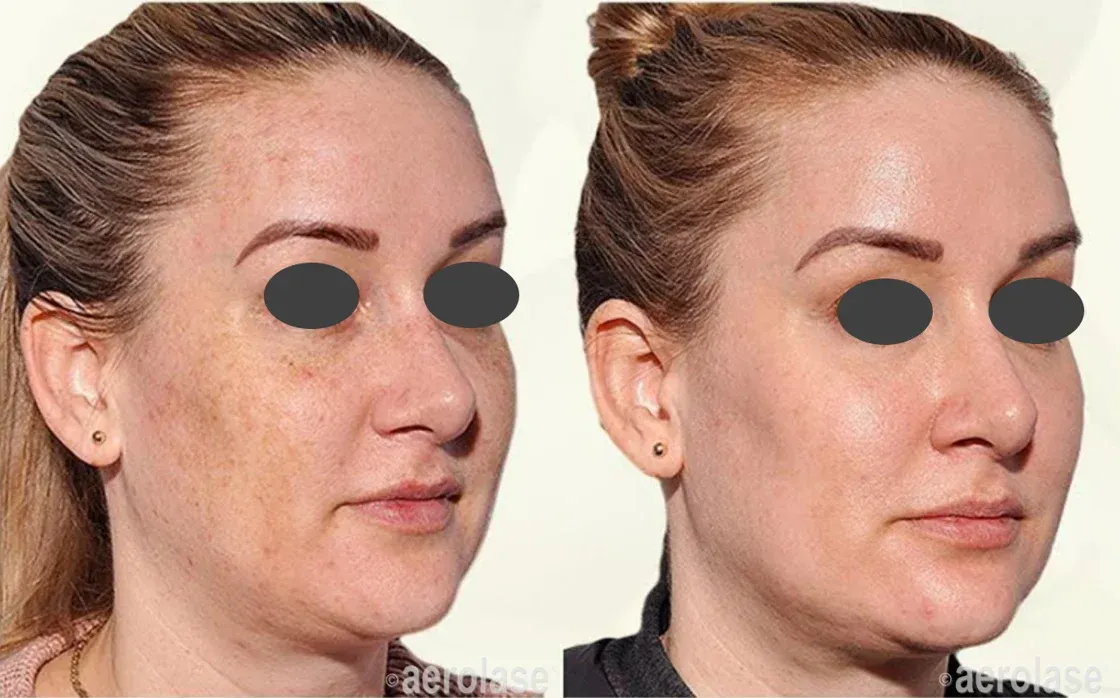 Before-and-after of a person's face showing reduction of brown spots and improved skin tone.