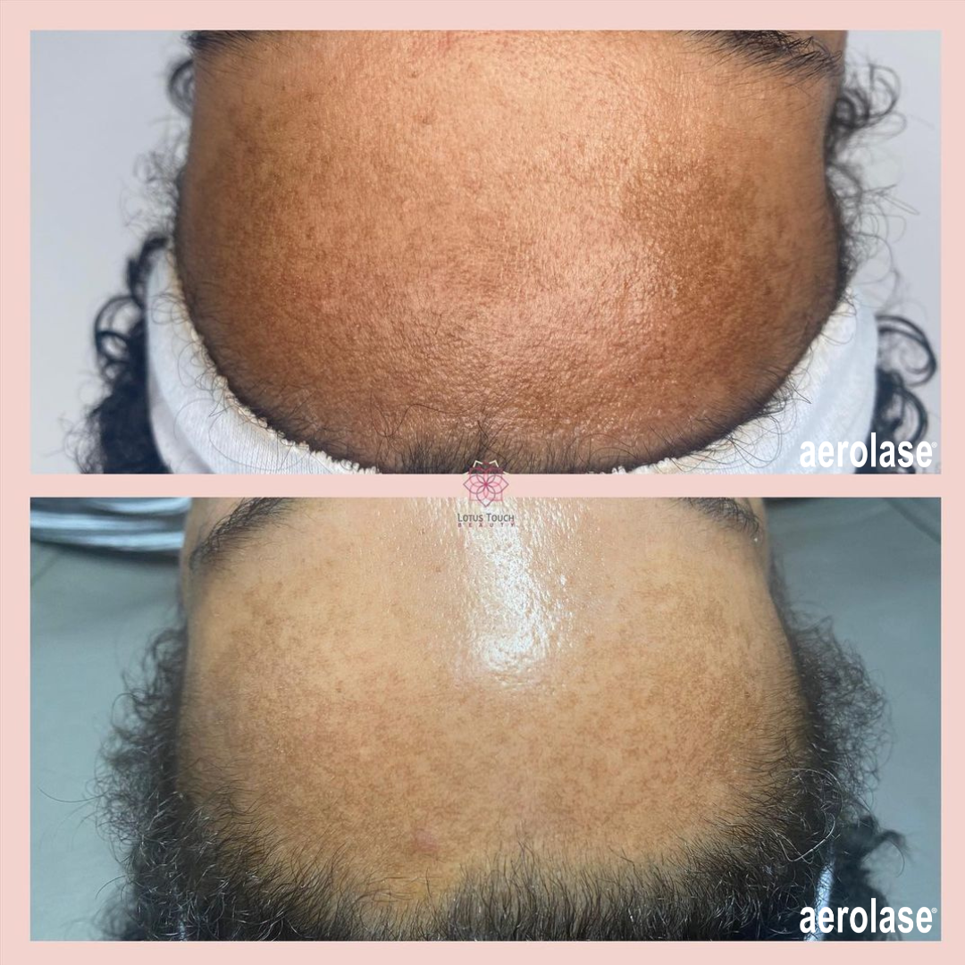 Comparison of skin before and after laser treatment. Skin appears smoother, with fewer blemishes.