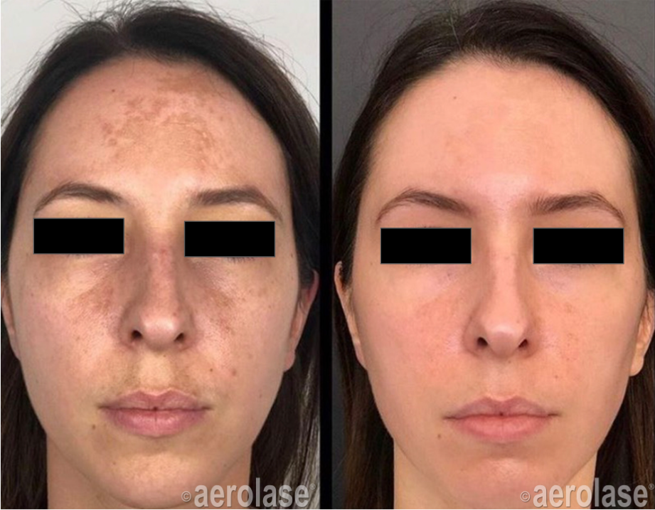 Before and after photo of a woman's face, showing reduction in dark spots after laser treatment.