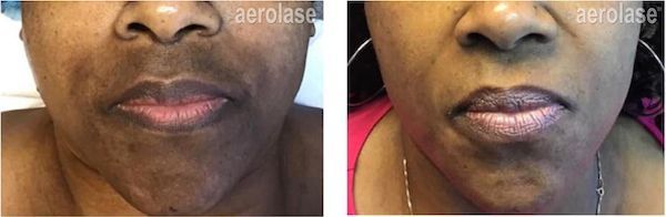Before and after close-up of a person's mouth, showing a reduction in dark spots. Aerolase.
