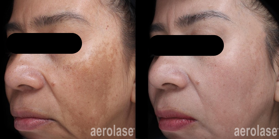 Side-by-side photos of a person's face. The left side has dark spots, the right side is lighter.