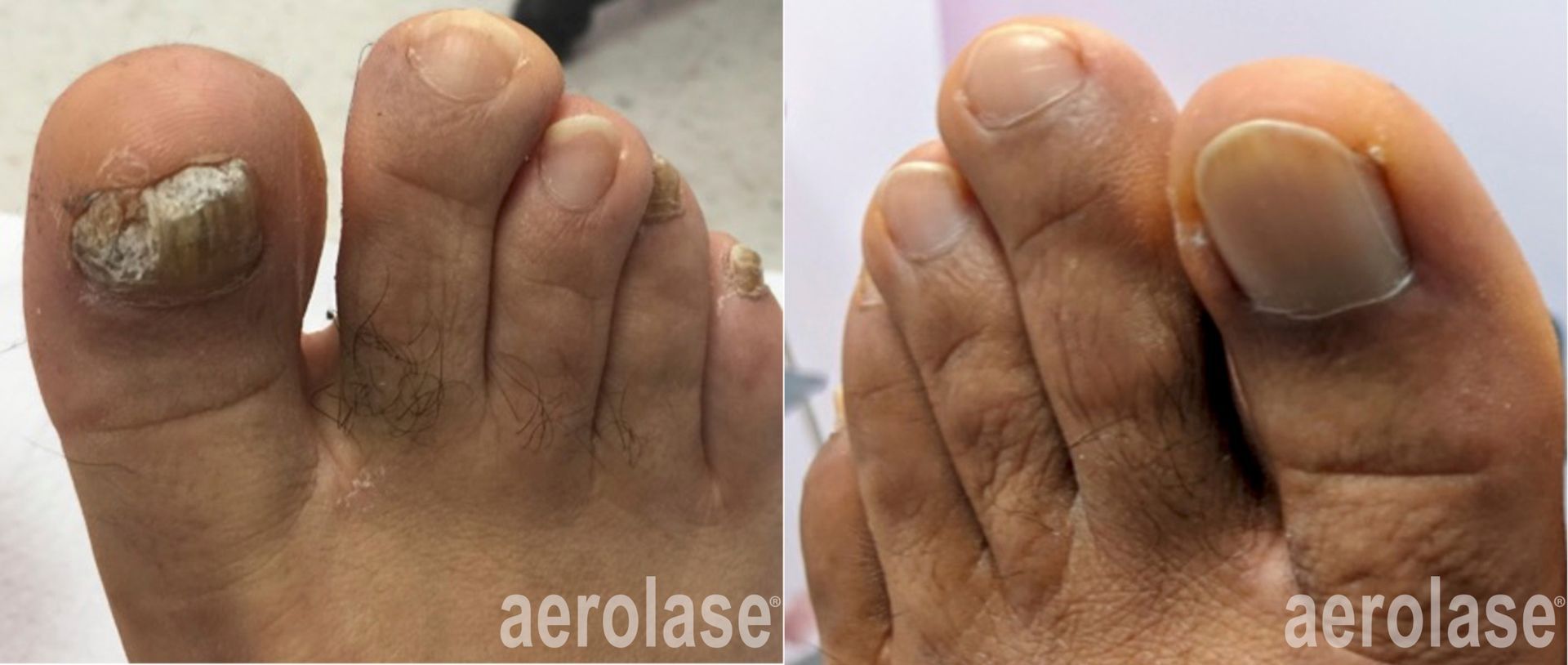 Before-and-after of a toe with toenail fungus, showing improvement after treatment.