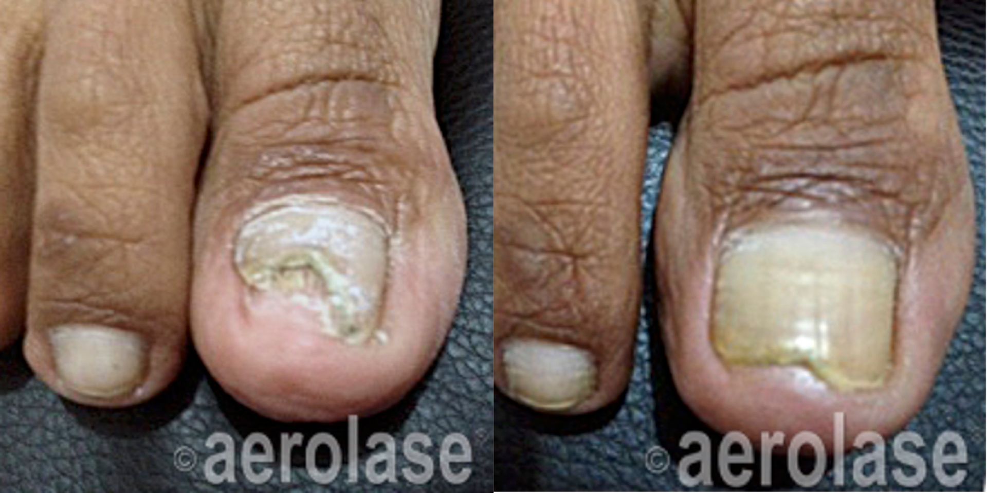 Before and after photos of a toenail with fungal infection treated with Aerolase laser.