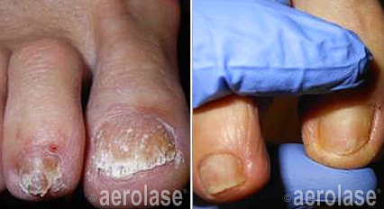 Left: Toenails with fungal infection. Right: Healthy toenails.