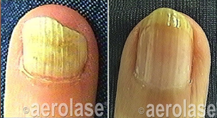 Two toenails with yellowed, thickened surfaces, possibly from a fungal infection.